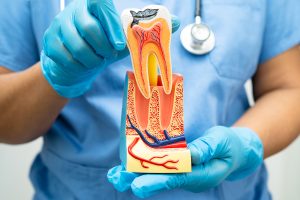 How Long Can You Put Off a Root Canal and What Happens If You Delay Treatment Too Long