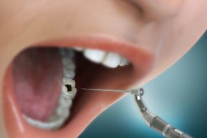 Archway Endodontics Celebrates Five Years of Specialty Root Canal Care in St. Louis
