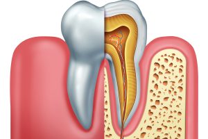 How Long Does A Root Canal Last Without a Crown?