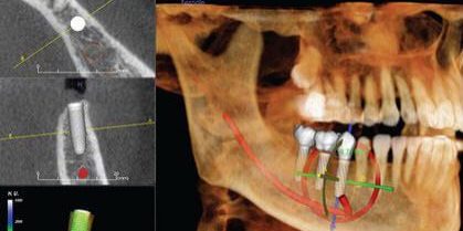 CT Guided Dental Implants